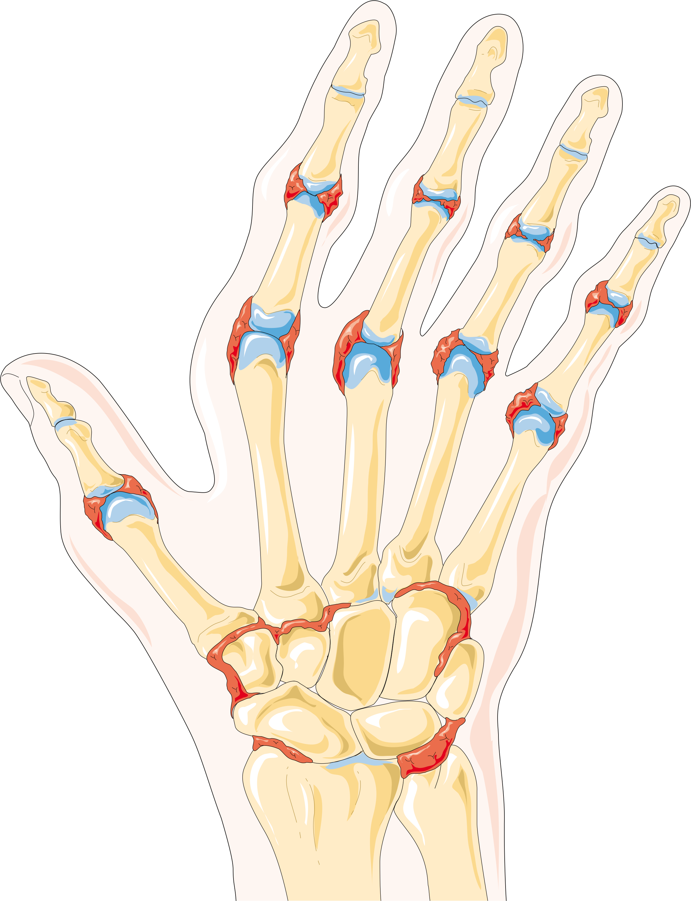 6 Types of Arthritis