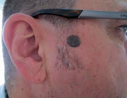 FAQs About Skin Moles