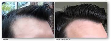 Hair Restoration Innovations: What's New in 2025?