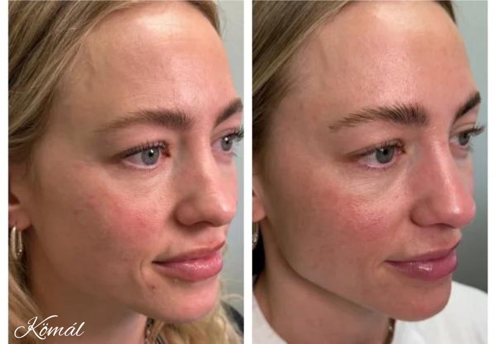 How Neurotoxin Can Be Used to Treat More Than Just Wrinkles