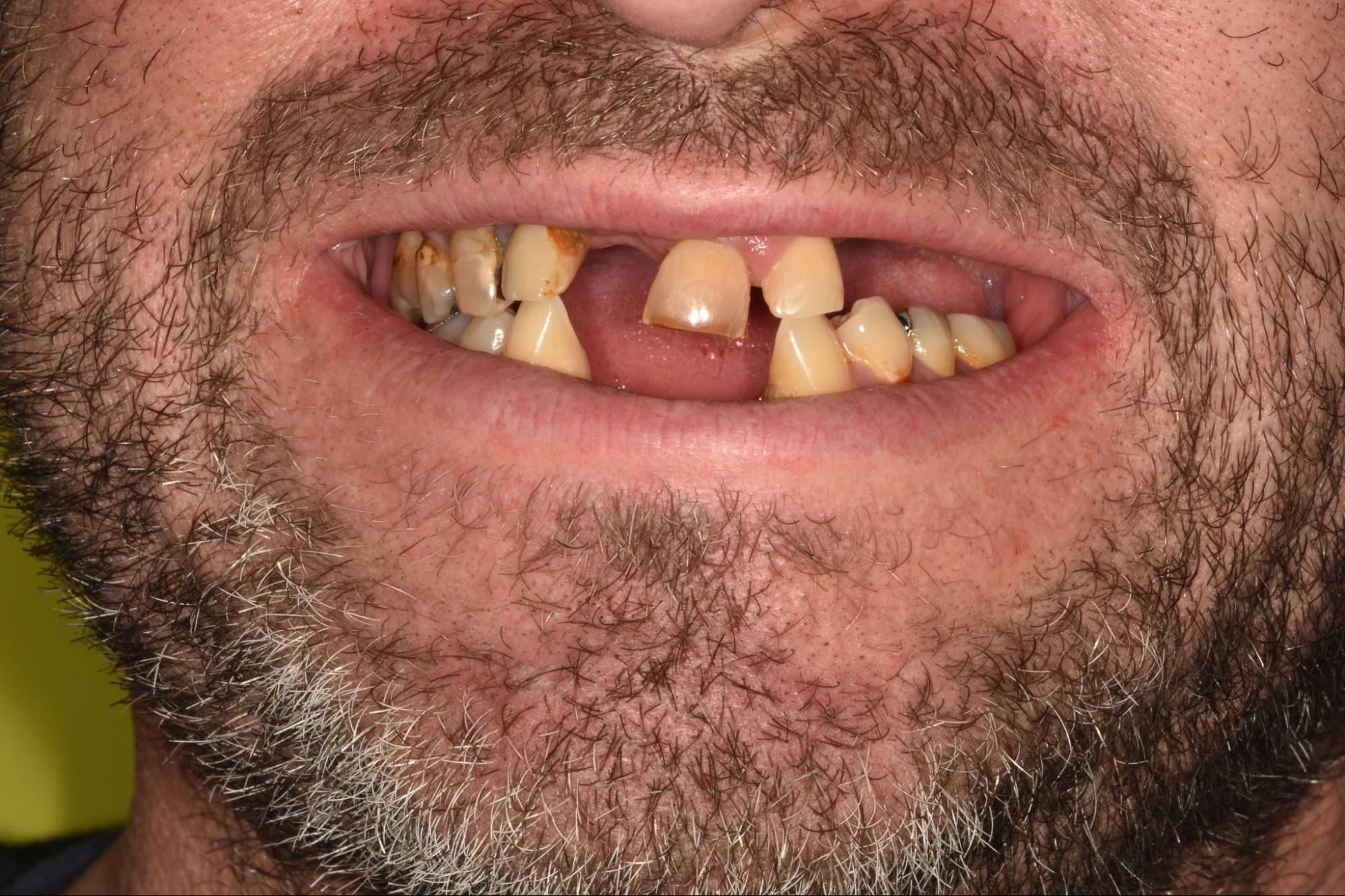 How Smoking Affects Your Teeth's Whiteness