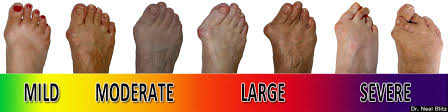 How to Recognize Early Signs of a Bunion