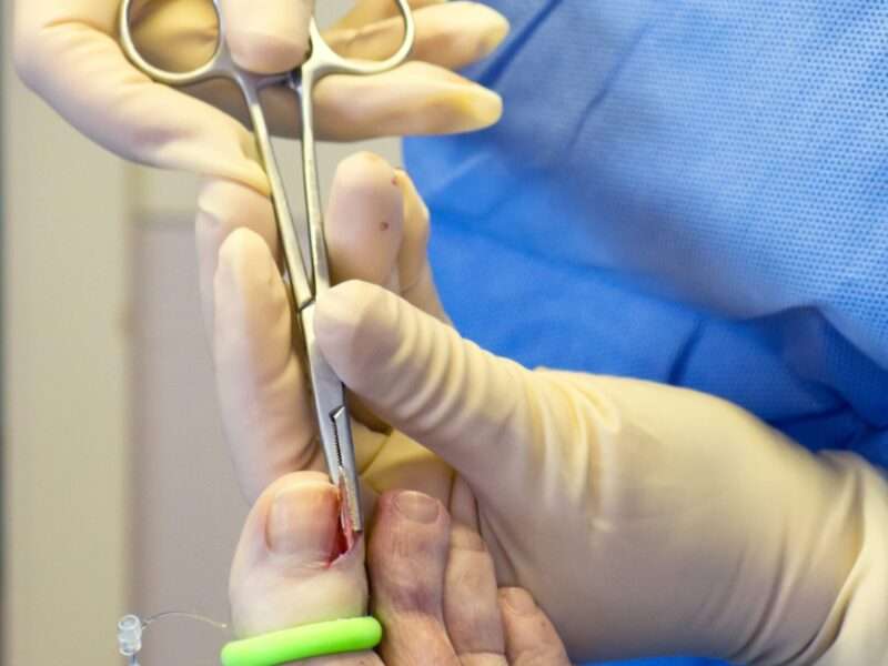 Plantar Warts vs Corns How to Tell the Difference