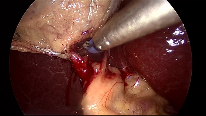 Post-Operative Care After Gallbladder Surgery