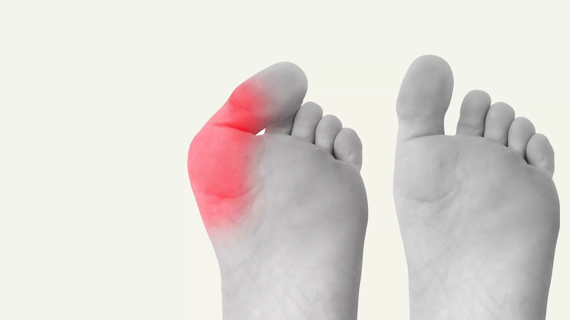 Surgical vs. Non-Surgical Treatment for Bunions: What’s Best for You?