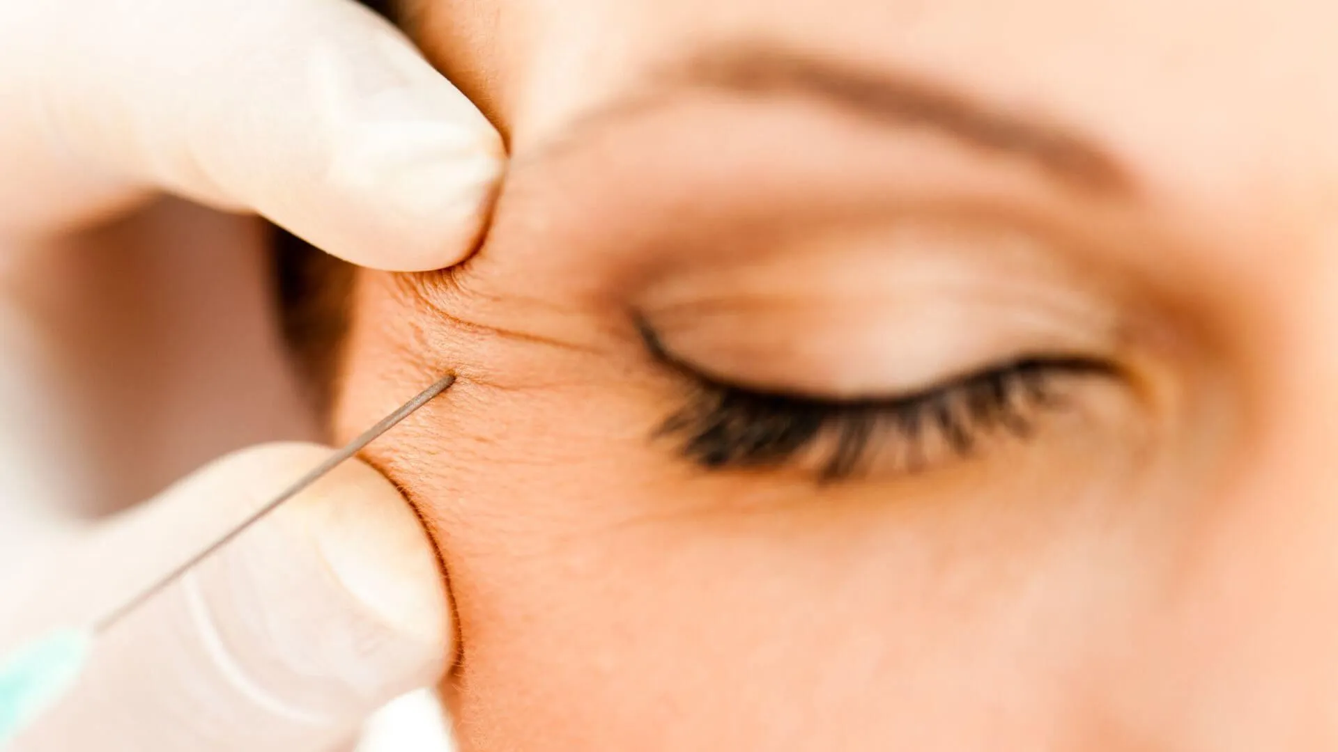 The Benefits of Botox Beyond Cosmetic Treatments