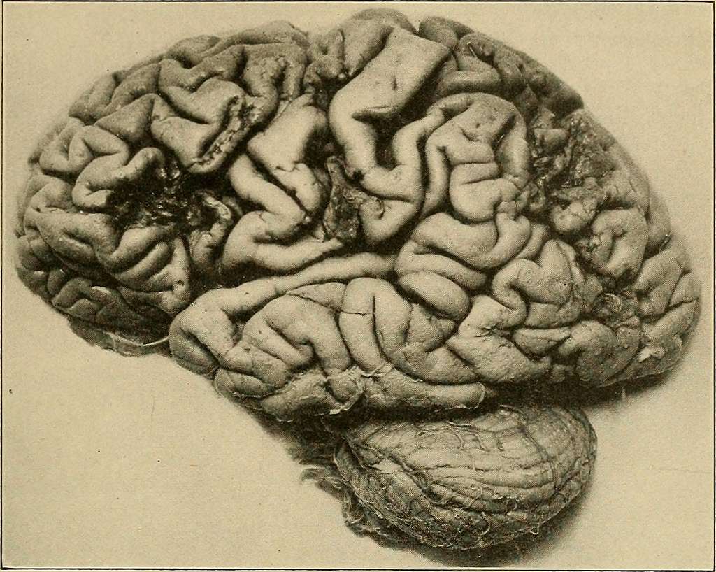 The Overlap Between Neurology and Psychiatry