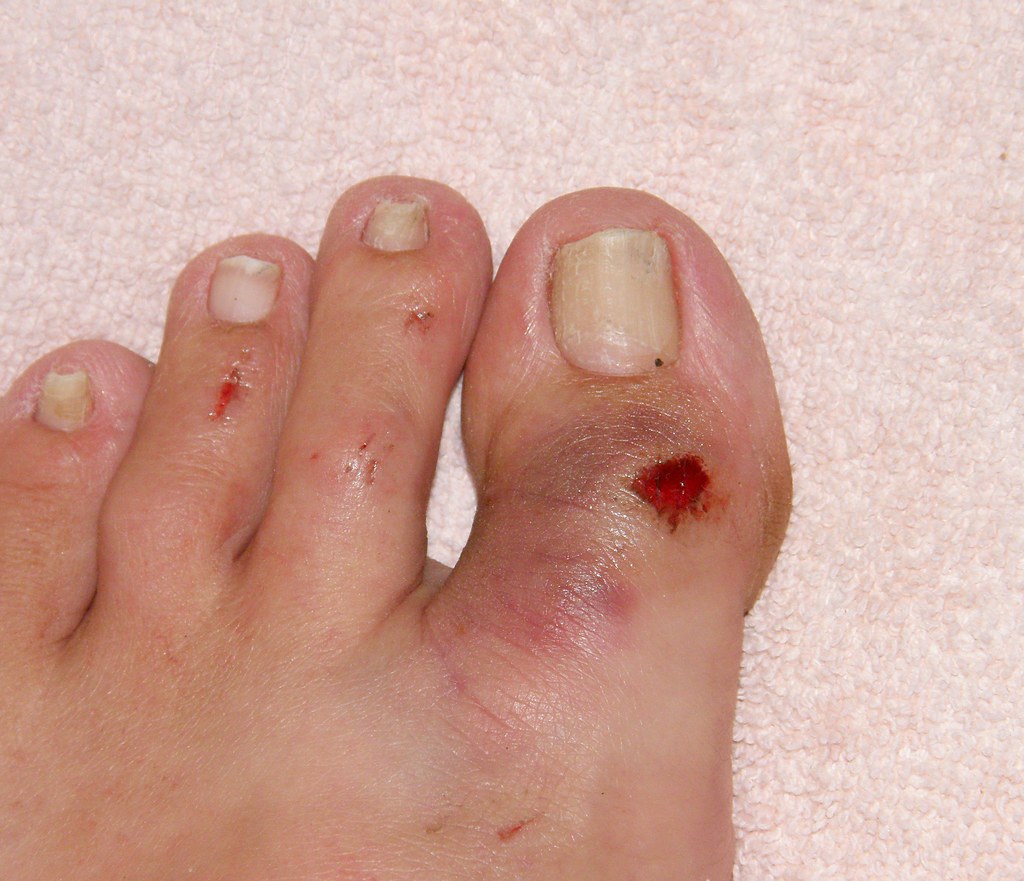 Tips to Manage Ingrown Toenail Pain