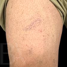 Understanding the Connection Between Spider Veins and Underlying Venous Health