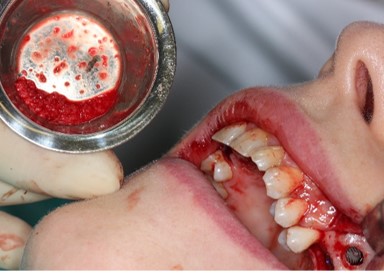 What You Need To Know Before a Sinus Lift