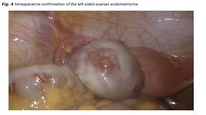 What to Expect From Uterine Fibroid Embolization