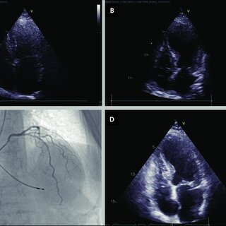 Why Every Heart Patient Should Consider Regular Echocardiograms